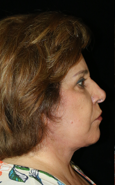 Facelift Before & After Patient #11848