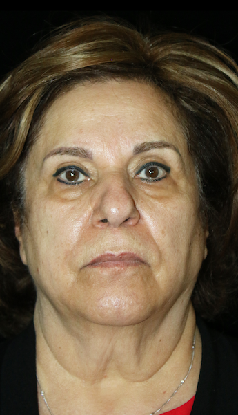 Facelift Before & After Patient #11848