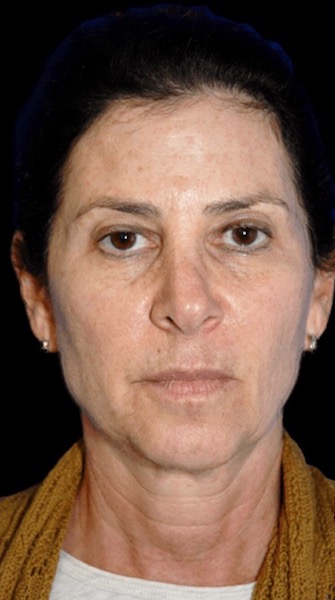 Facelift Before & After Patient #11855