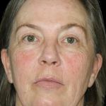 Facelift Before & After Patient #11860