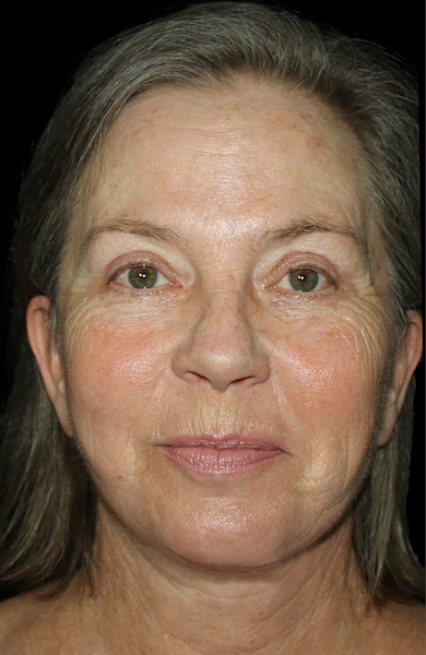 Facelift Before & After Patient #11860