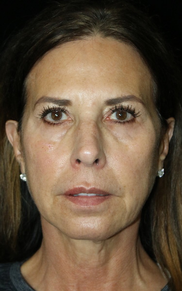 Facelift Before & After Patient #11868