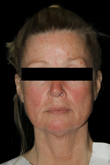 Facial Fat Grafting Before & After Patient #11883
