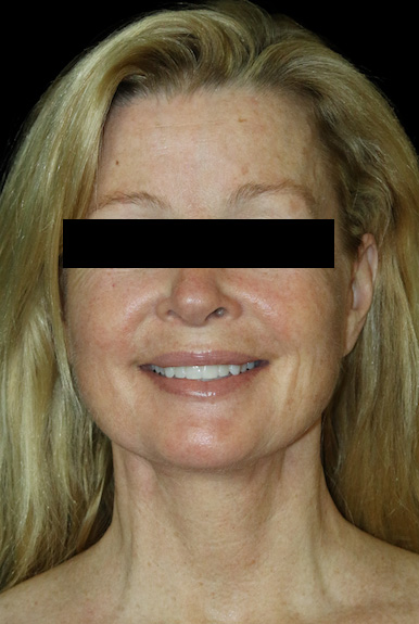 Facial Fat Grafting Before & After Patient #11883