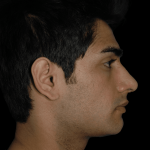 Primary Rhinoplasty Before & After Patient #11946
