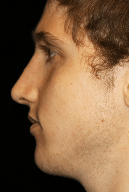 Rhinoplasty Before & After Patient #12010