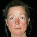 Facelift Before & After Patient #11883