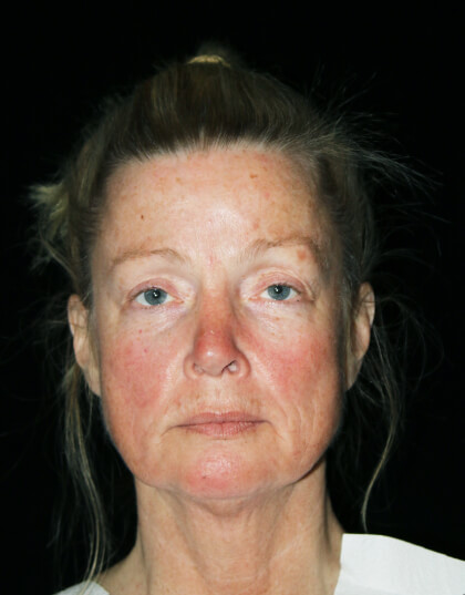 Facelift Before & After Patient #11883