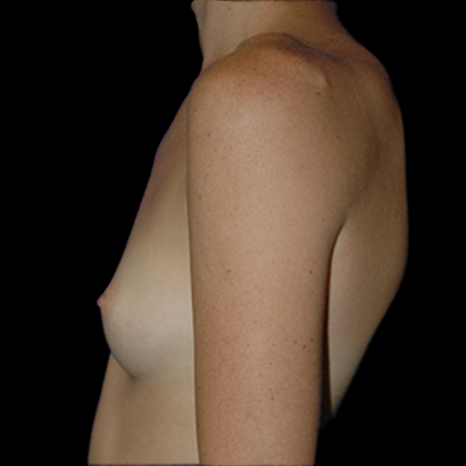 Breast Augmentation Before & After Patient #11547