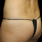 Brazilian Butt Lift Before & After Patient #11995