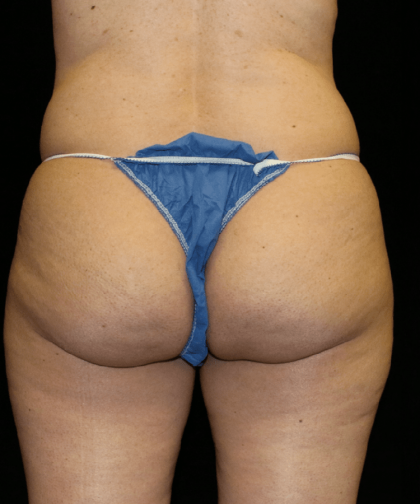 Brazilian Butt Lift Before & After Patient #12000