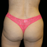 Brazilian Butt Lift Before & After Patient #12000