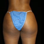 Brazilian Butt Lift Before & After Patient #11986