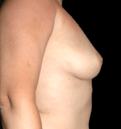 Fat Grafting Before & After Patient #11957