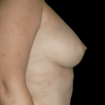 Fat Grafting Before & After Patient #11957