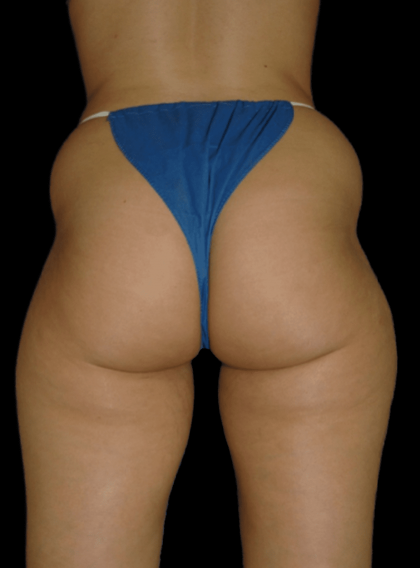 Brazilian Butt Lift Before & After Patient #12003