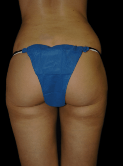 Brazilian Butt Lift Before & After Patient #12003