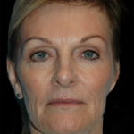 Facelift Before & After Patient #11620