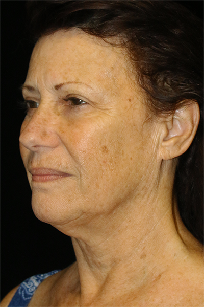 Facelift Before & After Patient #11573