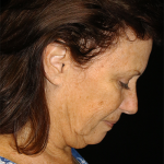 Facelift Before & After Patient #11573