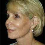 Facelift Before & After Patient #11580