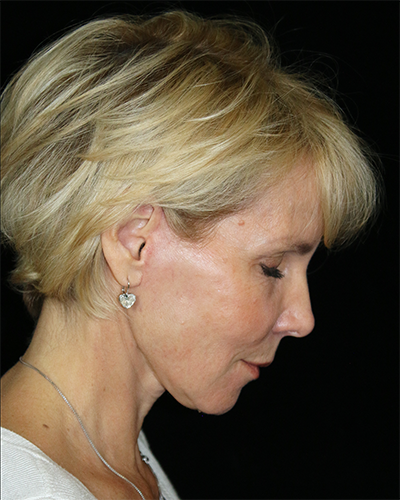 Facelift Before & After Patient #11580