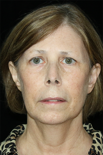 Facelift Before & After Patient #11594