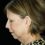 Facelift Before & After Patient #11594