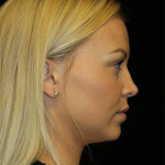 Facial Fat Grafting Before & After Patient #11623