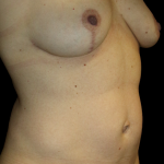 Abdominal Liposuction Before & After Patient #11890