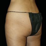 Brazilian Butt Lift Before & After Patient #12308