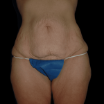 Tummy Tuck Before & After Patient #12319