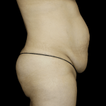 Tummy Tuck Before & After Patient #12333