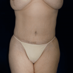 Tummy Tuck Before & After Patient #12298