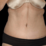 Tummy Tuck Before & After Patient #12303