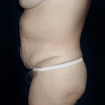 Tummy Tuck Before & After Patient #12298