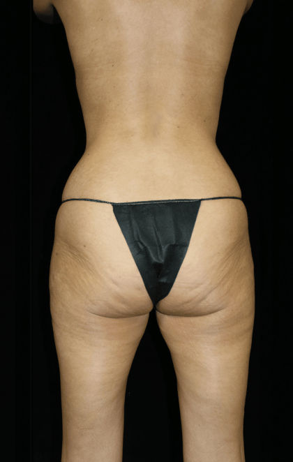 Brazilian Butt Lift Before & After Patient #12308