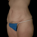 Tummy Tuck Before & After Patient #12319