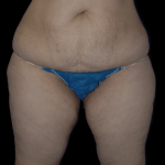 Tummy Tuck Before & After Patient #12326