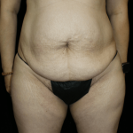 Tummy Tuck Before & After Patient #12333