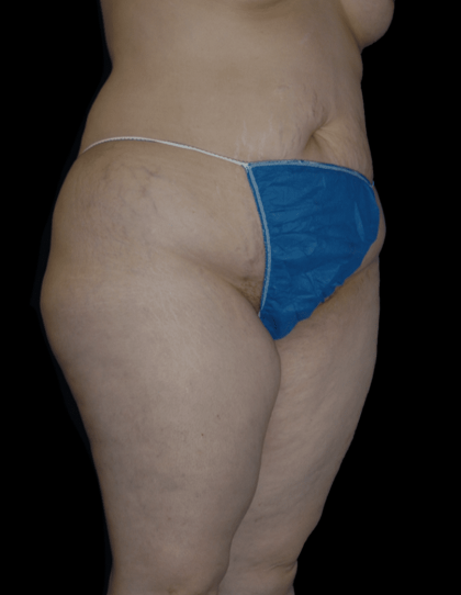 Tummy Tuck Before & After Patient #12326
