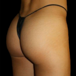 Brazilian Butt Lift Before & After Patient #12282