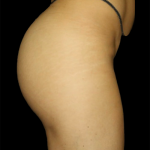 Brazilian Butt Lift Before & After Patient #12282
