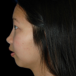 Rhinoplasty Before & After Patient #12094