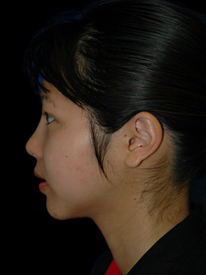 Rhinoplasty Before & After Patient #12094