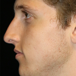Primary Rhinoplasty Before & After Patient #12119