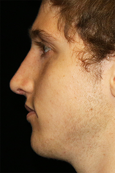 Primary Rhinoplasty Before & After Patient #12119