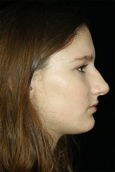 Primary Rhinoplasty Before & After Patient #12270