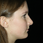 Primary Rhinoplasty Before & After Patient #12270