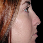 Primary Rhinoplasty Before & After Patient #12109